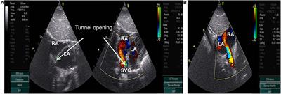 Congenital Descending Aorta-Right Atrial Tunnel: A Case Report